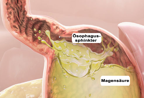 Ösophagussphinkter