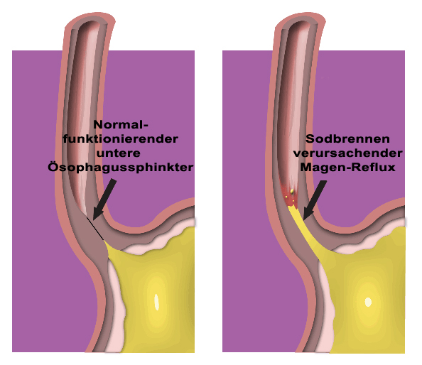 Reflux und Sodbrennen