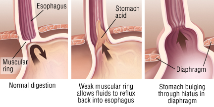 Zwerchfellhernie und Reflux